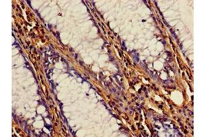 Immunohistochemistry of paraffin-embedded human colon cancer using ABIN7148987 at dilution of 1:100 (CSTB antibody  (AA 1-98))