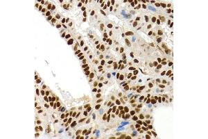 Immunohistochemistry of paraffin-embedded human thyroid cancer using MT2A antibody (ABIN1873764) at dilution of 1:200 (40x lens). (MT2A antibody)