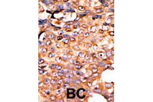 Formalin-fixed and paraffin-embedded human cancer tissue reacted with PANK3 polyclonal antibody  , which was peroxidase-conjugated to the secondary antibody, followed by AEC staining. (PANK3 antibody  (Internal Region))