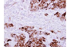IHC-P Image Fibrinogen gamma antibody detects FGG protein at cytosol on human breast cancer by immunohistochemical analysis. (FGG antibody)