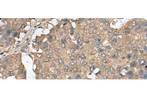 Immunohistochemistry of paraffin-embedded Human liver cancer tissue using EIF4A2 Polyclonal Antibody at dilution of 1:65(x200) (EIF4A2 antibody)
