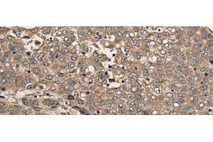 Immunohistochemistry of paraffin-embedded Human liver cancer tissue using CDC20B Polyclonal Antibody at dilution of 1:30(x200) (CDC20B antibody)