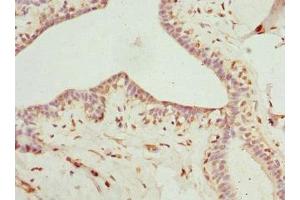 Immunohistochemistry of paraffin-embedded human breast cancer using ABIN7158965 at dilution of 1:100 (Mammaglobin A antibody  (AA 1-93))
