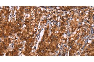 Immunohistochemistry of paraffin-embedded Human gastric cancer using BRK1 Polyclonal Antibody at dilution of 1:40