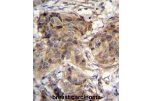 TTC9C Antibody (N-term) immunohistochemistry analysis in formalin fixed and paraffin embedded human breast carcinoma followed by peroxidase conjugation of the secondary antibody and DAB staining. (TTC9C antibody  (N-Term))