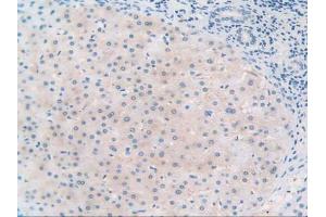 IHC-P analysis of Human Liver Cancer Tissue, with DAB staining. (TLR3 antibody  (AA 404-532))