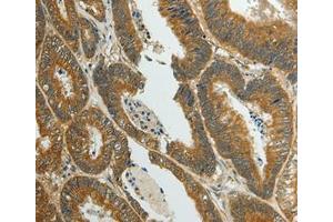Immunohistochemical analysis of paraffin-embedded Human colon cancer tissue using at dilution 1/70. (SUN5 antibody  (Internal Region))