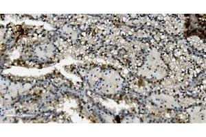 IHC analysis of Transketolase/TKT using anti-Transketolase/TKT antibody (ABIN7598958). (TKT antibody  (AA 1-116))