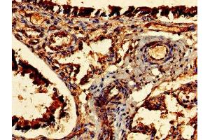 Immunohistochemistry of paraffin-embedded human lung tissue using ABIN7147484 at dilution of 1:100 (CDR2 antibody  (AA 1-454))