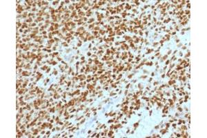 IHC testing of FFPE Ewings sarcoma with NKX2. (Nkx2-2 antibody  (AA 1-119))