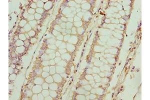 Immunohistochemistry of paraffin-embedded human colon cancer using ABIN7152907 at dilution of 1:100 (FSIP1 antibody  (AA 101-400))