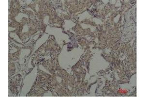 Immunohistochemistry (IHC) analysis of paraffin-embedded Human Breast Carcicnoma using c-Fos Mouse Monoclonal Antibody diluted at 1:200. (c-FOS antibody)