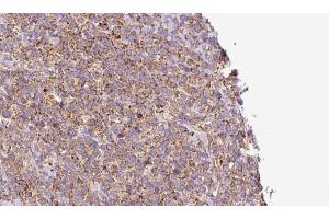 ABIN6273185 at 1/100 staining Human lymph cancer tissue by IHC-P. (WBP2NL antibody  (Internal Region))