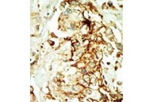 Formalin-fixed and paraffin-embedded human cancer tissue (breast carcinoma) reacted with the primary antibody, which was peroxidase-conjugated to the secondary antibody, followed by DAB staining. (MAPK10 antibody  (N-Term))