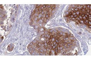 ABIN6277433 at 1/100 staining Human urothelial cancer tissue by IHC-P. (SLC1A4 antibody  (C-Term))