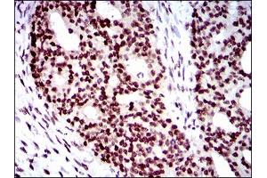 Immunohistochemical analysis of paraffin-embedded ovarian cancer tissues using WHSC2 mouse mAb with DAB staining.