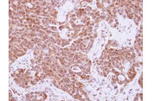 IHC-P Image Immunohistochemical analysis of paraffin-embedded human lung adenocarcinoma, using Cyclin A2, antibody at 1:250 dilution. (Cyclin A antibody  (C-Term))