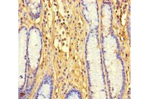 Immunohistochemistry of paraffin-embedded human gastric cancer using ABIN7165770 at dilution of 1:100 (LTV1 antibody  (AA 201-475))