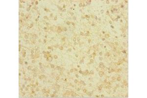 Immunohistochemistry of paraffin-embedded human glioma using ABIN7154046 at dilution of 1:100 (Glutaredoxin 1 antibody  (AA 1-106))