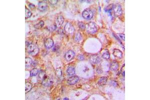 Immunohistochemical analysis of Caspase 1 staining in human lung cancer formalin fixed paraffin embedded tissue section.