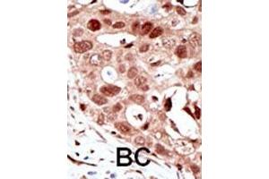 Formalin-fixed and paraffin-embedded human cancer tissue reacted with the primary antibody, which was peroxidase-conjugated to the secondary antibody, followed by AEC staining. (SUMO2 antibody  (C-Term))
