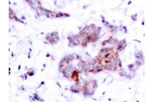 Immunohistochemical analysis of paraffin-embedded human breast cancer tissue using REL polyclonal antibody . (c-Rel antibody)