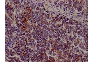 IHC image of ABIN7127588 diluted at 1:100 and staining in paraffin-embedded human lung cancer performed on a Leica BondTM system. (Recombinant JAK3 antibody)