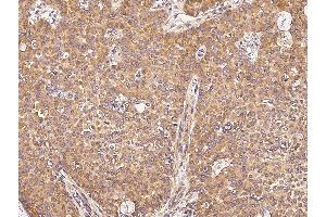 Immunochemical staining of human UBE4A in human breast carcinoma with rabbit polyclonal antibody (0.