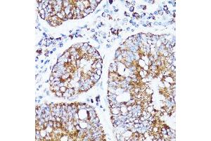 Immunohistochemistry of paraffin-embedded human colon carcinoma using CYCS antibody. (Cytochrome C antibody  (AA 1-105))