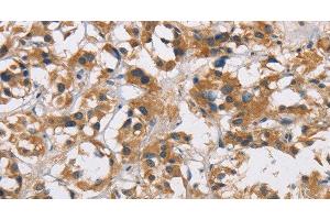 Immunohistochemistry of paraffin-embedded Human thyroid cancer tissue using CYP21A2 Polyclonal Antibody at dilution 1:60 (CYP21A2 antibody)