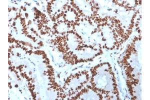 Formalin-fixed, paraffin-embedded human Colon Carcinoma stained with MCM6 Mouse Monoclonal Antibody (MCM6/3000).