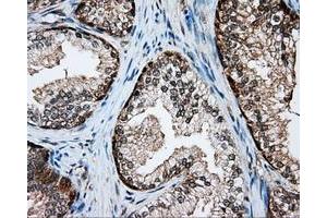Immunohistochemical staining of paraffin-embedded Adenocarcinoma of colon tissue using anti-SRR mouse monoclonal antibody. (SRR antibody)