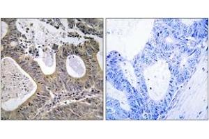 Immunohistochemistry analysis of paraffin-embedded human colon carcinoma tissue, using STEA2 Antibody. (STEAP2 antibody  (AA 431-480))