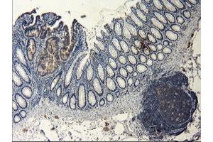 Immunohistochemical staining of paraffin-embedded Human colon tissue using anti-LGR5 mouse monoclonal antibody. (LGR5 antibody  (AA 250-550))