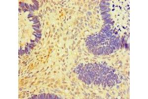 Immunohistochemistry of paraffin-embedded human ovarian cancer using ABIN7150987 at dilution of 1:100 (RNF2 antibody  (AA 1-100))