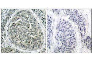 Immunohistochemical analysis of paraffin-embedded human breast carcinoma tissue, using β-Catenin (phospho-Ser37) antibody (E011219). (beta Catenin antibody  (pSer37))