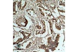 Immunohistochemical analysis of Cyclin B1 staining in human breast cancer formalin fixed paraffin embedded tissue section. (Cyclin B1 antibody)