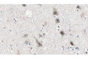 ABIN6274945 at 1/100 staining Human brain cancer tissue by IHC-P. (ABCC3 antibody  (Internal Region))