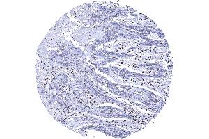Esophagus Squamous cell carcinoma with reduced Ku80 staining of tumor cells as compared to stroma cells