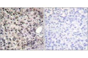 Immunohistochemistry analysis of paraffin-embedded human breast carcinoma, using DDX5/DEAD-box Protein 5 (Phospho-Tyr593) Antibody. (DDX5 antibody  (pTyr593))