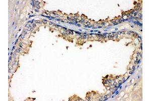 Anti- BMPR1B Picoband antibody,IHC(P) IHC(P): Human Prostatic Cancer Tissue (BMPR1B antibody  (AA 14-184))
