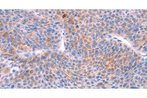 Immunohistochemistry of paraffin-embedded Human liver cancer using AADAC Polyclonal Antibody at dilution of 1:30 (AADAC antibody)