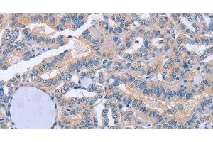 Immunohistochemistry of paraffin-embedded Human thyroid cancer tissue using BOD1 Polyclonal Antibody at dilution 1:60