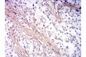 Immunohistochemical analysis of paraffin-embedded bladder cancer tissues using PINK1 mouse mAb with DAB staining. (PINK1 antibody  (AA 112-273))
