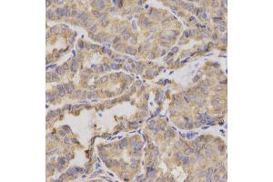 Immunohistochemistry of paraffin-embedded human thyroid cancer using XRCC2 antibody. (XRCC2 antibody)