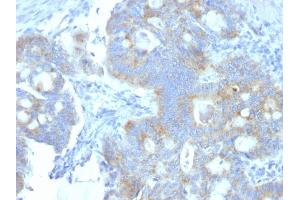 Formalin-fixed, paraffin-embedded human Colon Carcinoma stained with Heparan Sulfate Monoclonal Antibody (A7L6). (HSPG2 antibody)