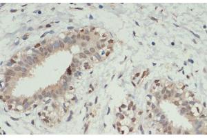 Immunohistochemistry of paraffin-embedded Human breast cancer using KDM6A Polyclonal Antibody at dilution of 1:200 (40x lens). (KDM6A antibody)