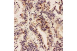 Anti-HSD11B1  antibody, IHC(P)IHC(P): Human Lung Cancer Tissue (HSD11B1 antibody  (N-Term))