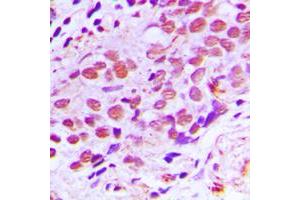 Immunohistochemical analysis of XPA staining in human breast cancer formalin fixed paraffin embedded tissue section. (XPA antibody  (C-Term))