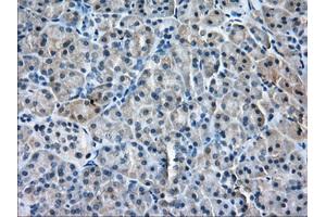 Immunohistochemical staining of paraffin-embedded Adenocarcinoma of Human ovary tissue using anti-PDE4A mouse monoclonal antibody.